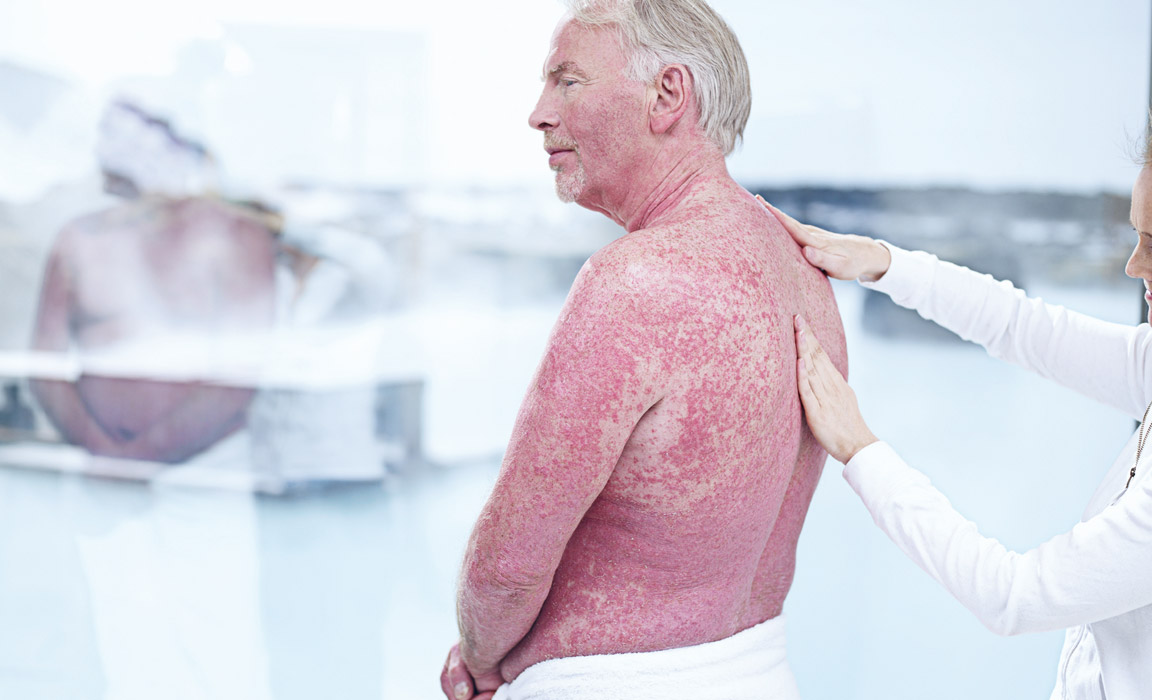 psoriasis