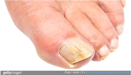 Mycoses des ongles des pieds : quel traitement ?